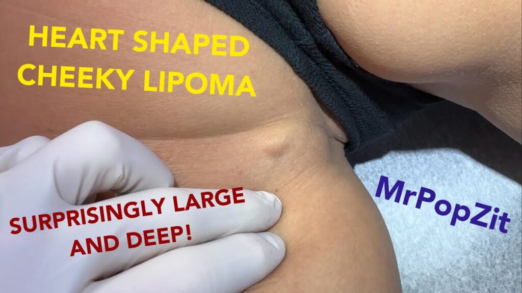 Very large hidden lipoma in a tricky area! You have to see it, it’s shaped just like a heart! 1
