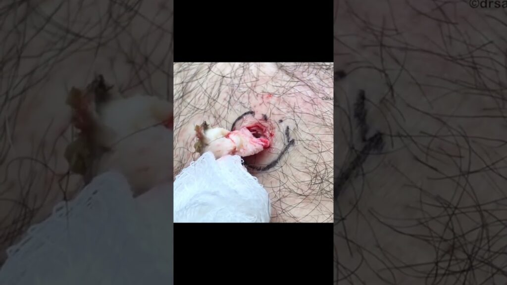 Tough Calcified Cyst Extraction 1