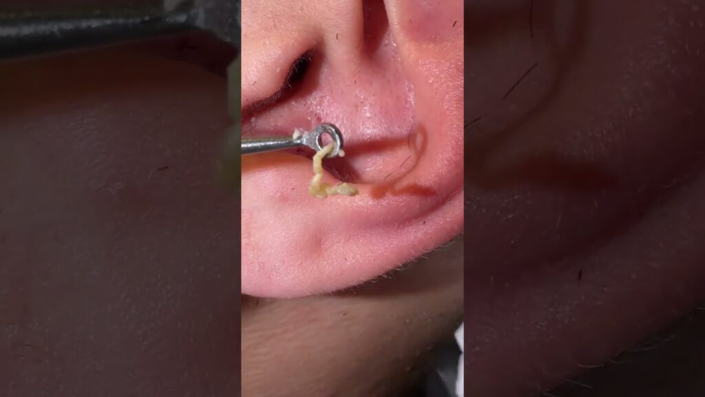 Tag removal ears black head 1