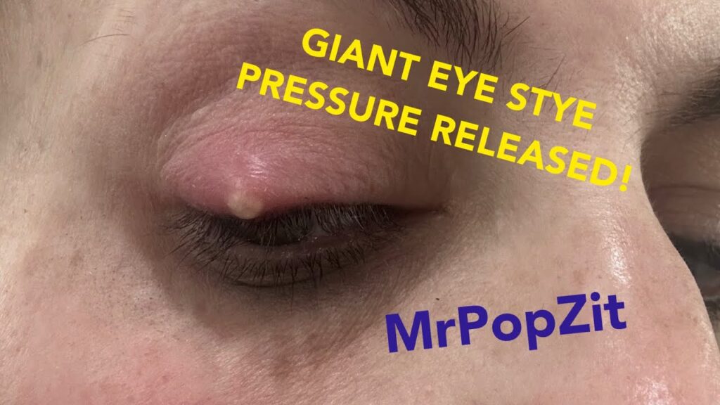 Giant stye on eyelid under immense pressure drained! Instant relief. Pocket of Purulence evacuated! 1