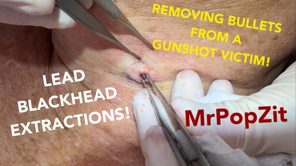 Removing lead blackheads from a gunshot victims neck and torso! See how the body treats a bullet! 1