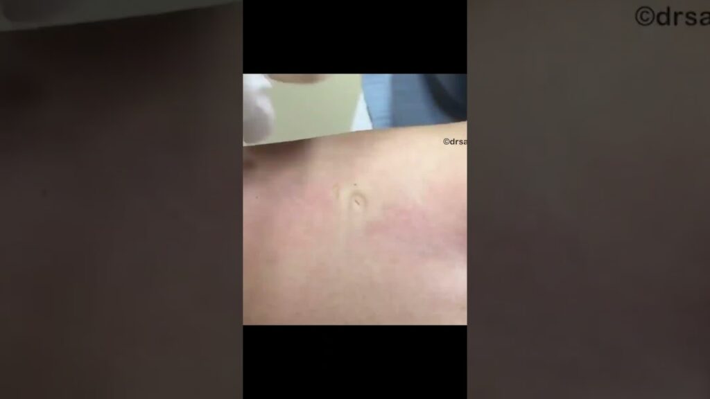 This was hiding under the skin! 1