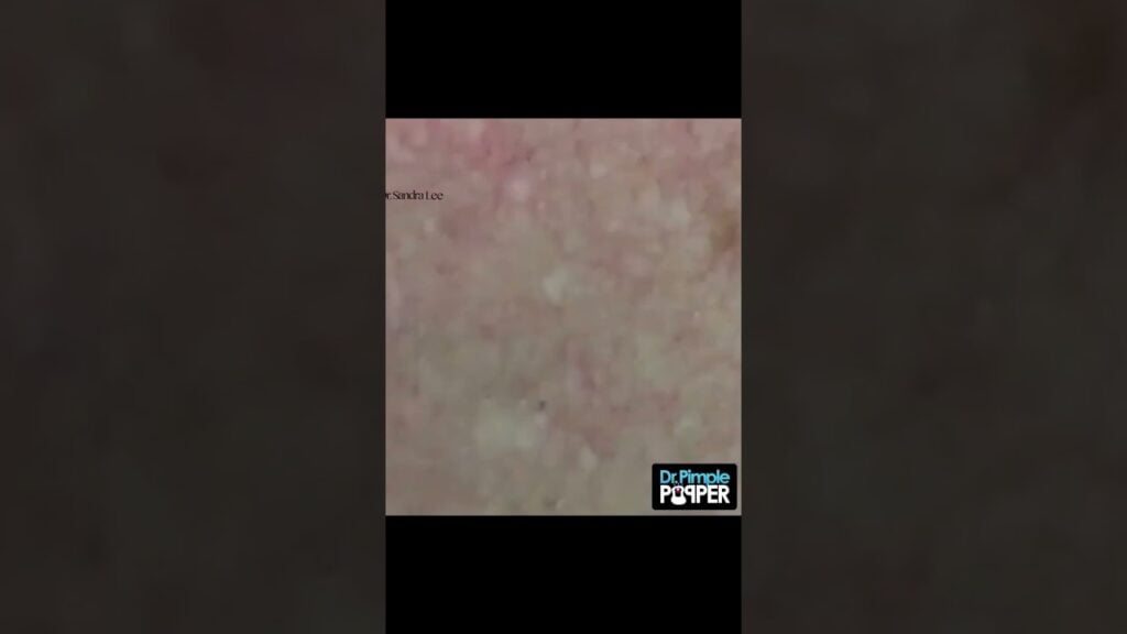 Stubborn blackhead vs. Dr. Pimple Popper 1