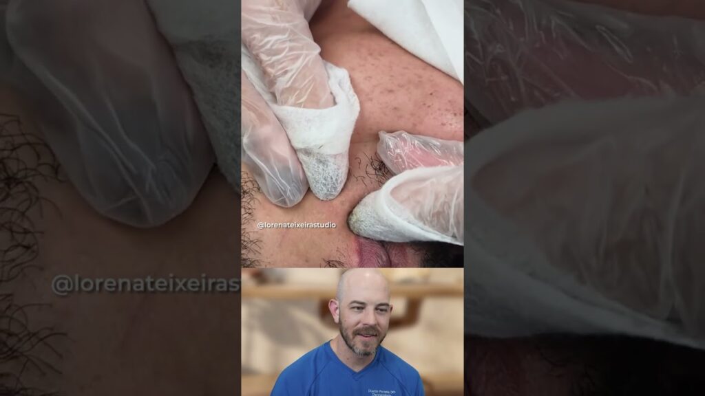 HydraFacial or Manual Extraction? 1