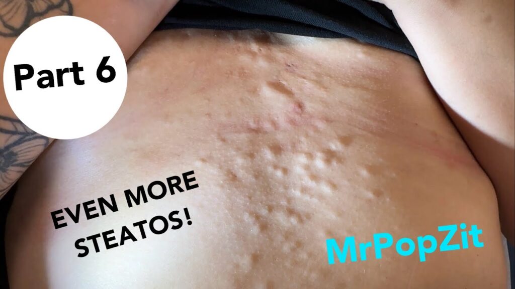 Deep buttery Steatocystoma pops on the chest! Her final session for clearance! Chest Extractions! 1