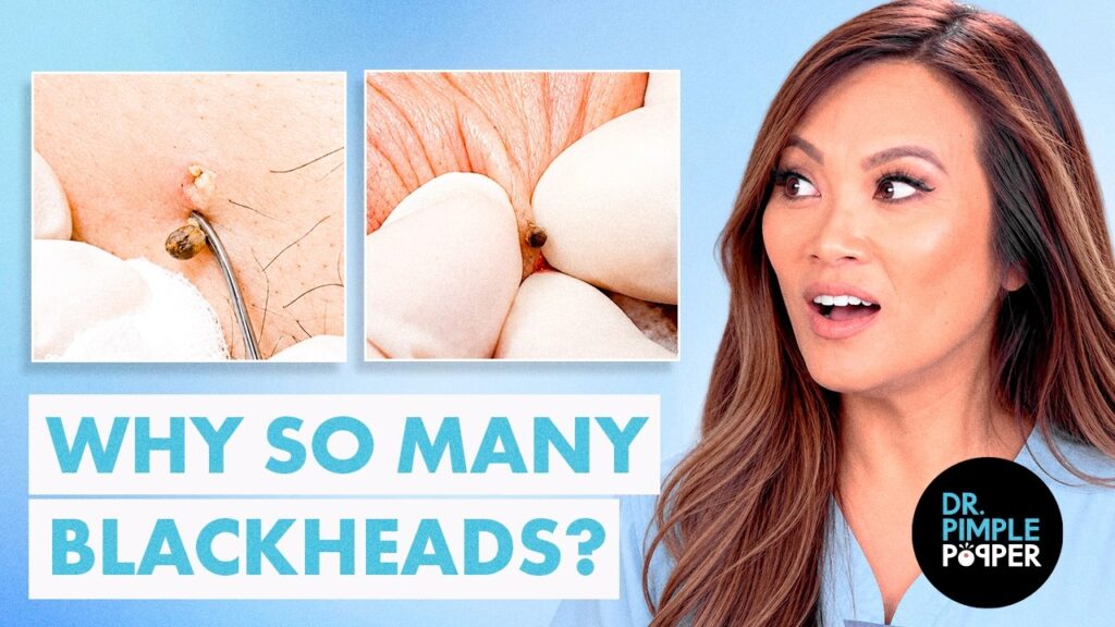 BLACKHEADS AFTER BLACKHEADS | They Just Keep Getting Better 1