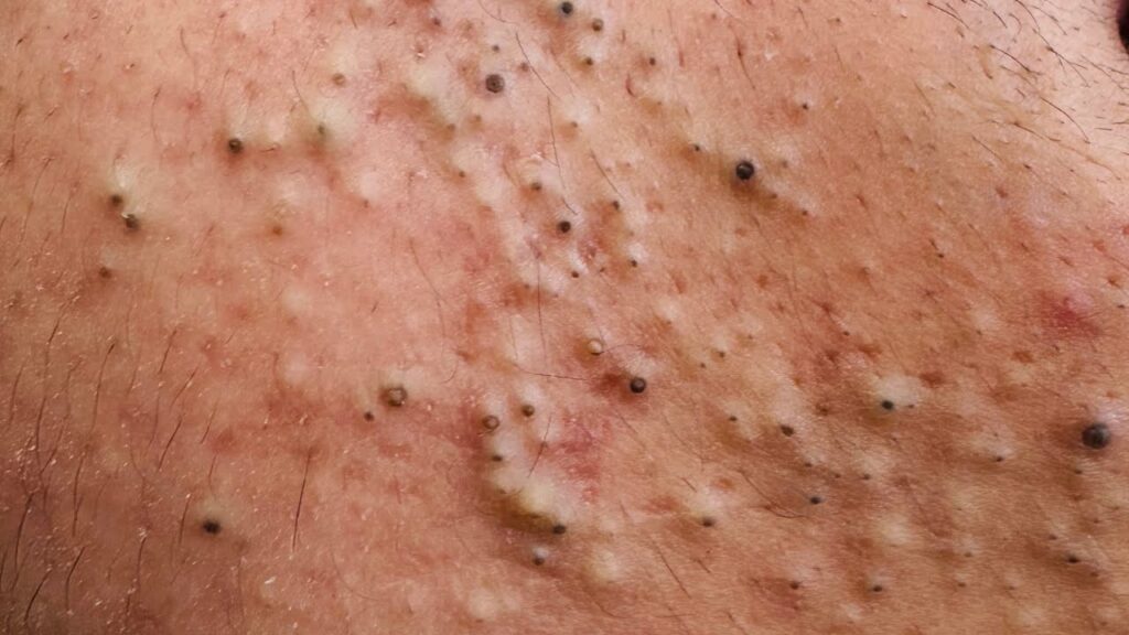 Enjoy Tag removal black head 1