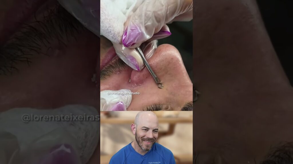 Are Sebaceous filaments extractions worth it? 1