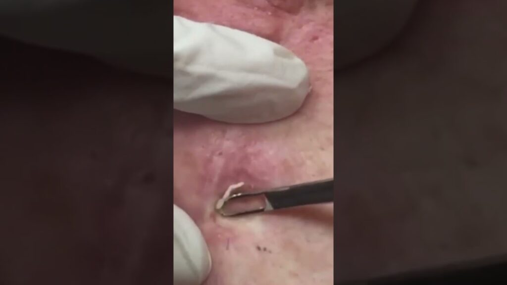 Deep Blackhead Extraction: Soft Pop 1