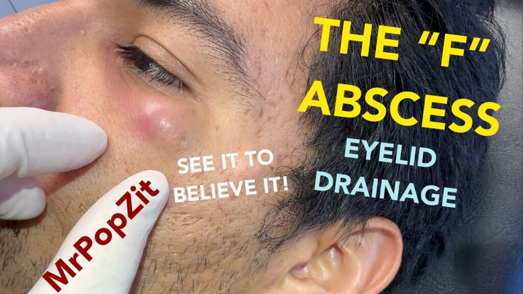 The abscess drainage spells the letter “F”, you gotta see it to believe it! Eyelid abscess drained. 1