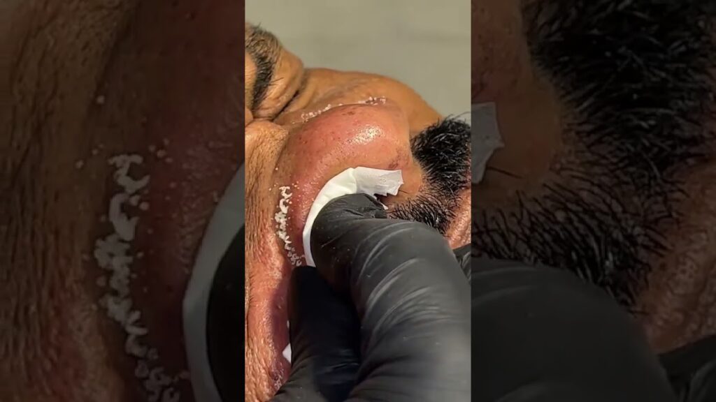 Big black head nose 1