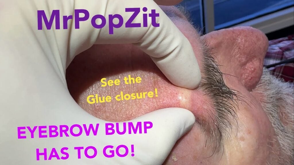 Eyebrow bump popped and removed!See the glue closure and the great follow up at the end!Minimal scar 1