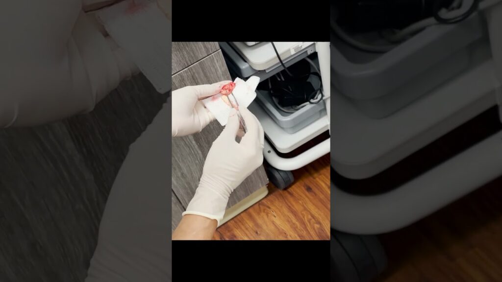 Why This Pilar Cyst Looks Like Egg Noodles 1