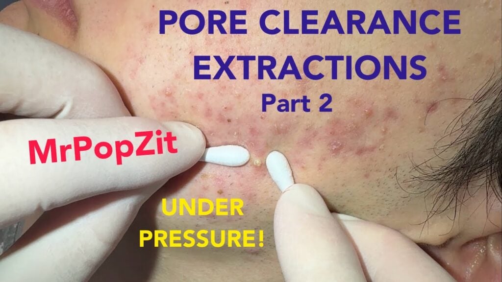 Inflammatory acne extractions!Pops have distance!Under pressure extraction pops for pore clearance! 1