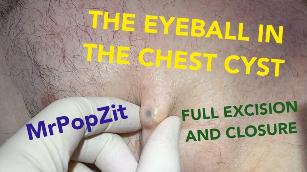 This growth looked just like an eyeball when it came out! Deeper than it looks!! Painful chest bump 1