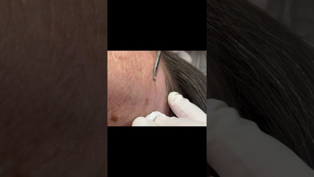 Don't Try This at Home: Milia Extraction 1