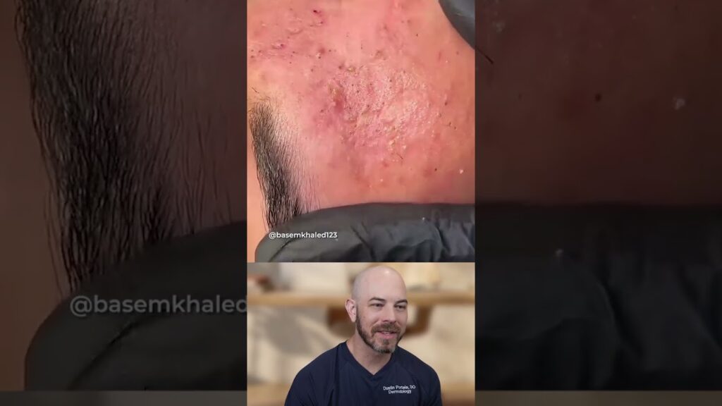 Forehead full of blackheads 1
