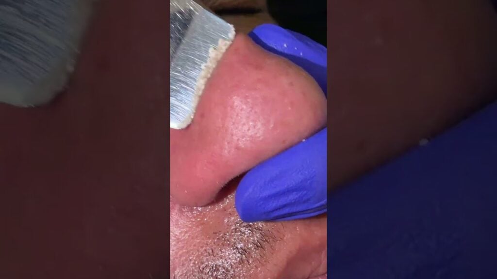 Black head nose 1