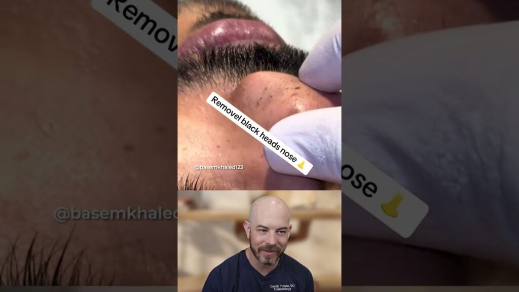 Are these blackheads trichostasis spinulosa? 1