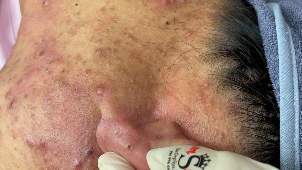 Relaxing Acne Treatment Session - SAC DEP SPA (Hue, Part 6) 1