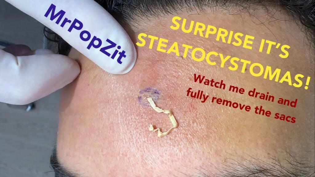 Surprise face bumps turn out to be Steatocystomas! Incision and drainage done with full sac removal 1