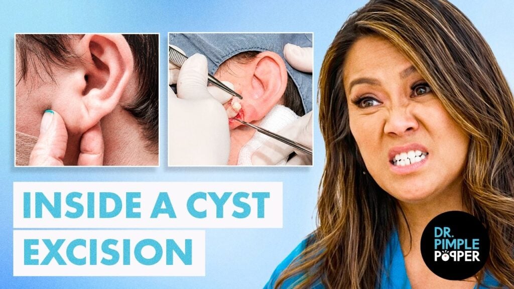 How an Earlobe Cyst Is Surgically Removed | Dr. Pimple Popper 1