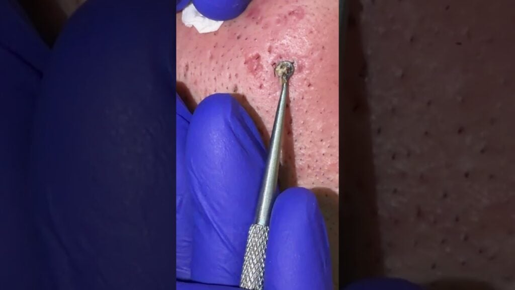 Deep Blackhead Extraction Close-Up - Basem Khaled 1