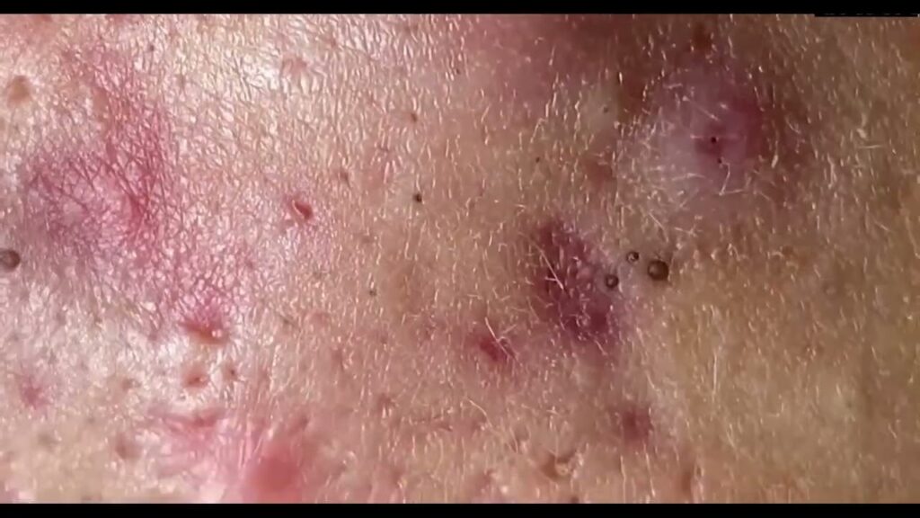 Extreme Blackhead Removal | Deep Pore Cleaning & Satisfying Extraction 1