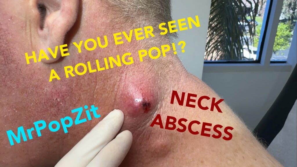 HAVE YOU EVER SEEN A ROLLING POP!?Giant neck abscess popped and the contents roll out into my hand! 1