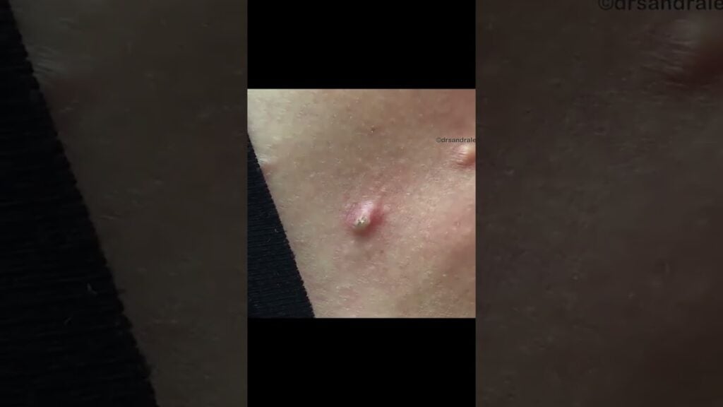 Dr. Pimple Popper Takes On a Tough Cyst 1