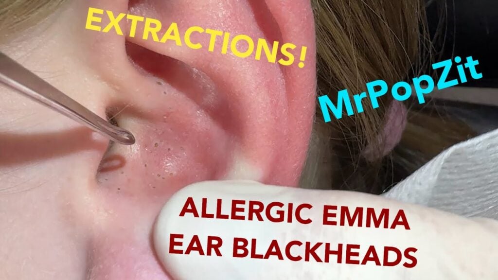 EAR BLACKHEAD EXTRACTIONS on a fellow YouTuber! Watch as I clear out her pores on her ear! 1