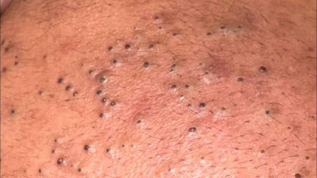 Old pimple and black head 1