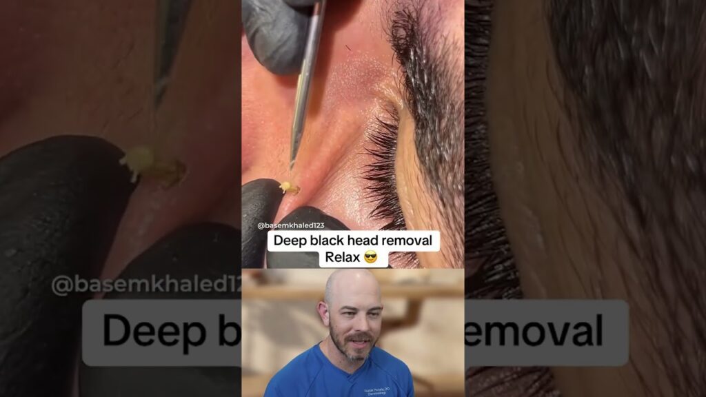 Deep black head removal 1