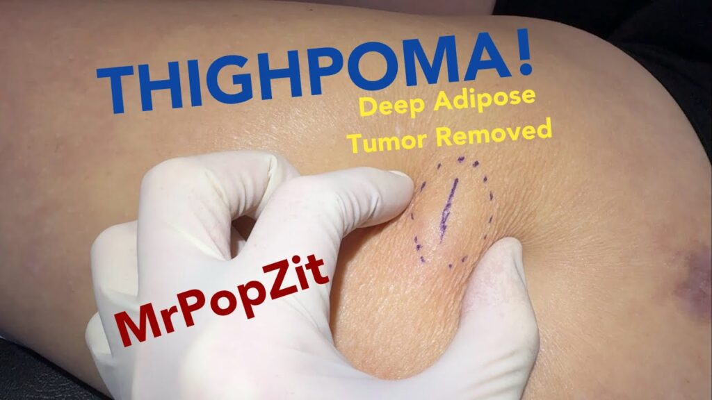 Deep adipose tissue fatty tumor removed.Pops out into my hand.Tender bump increasing in size is gone 1