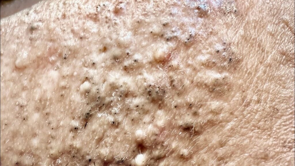 Dirty blackheads and cleaning them 1