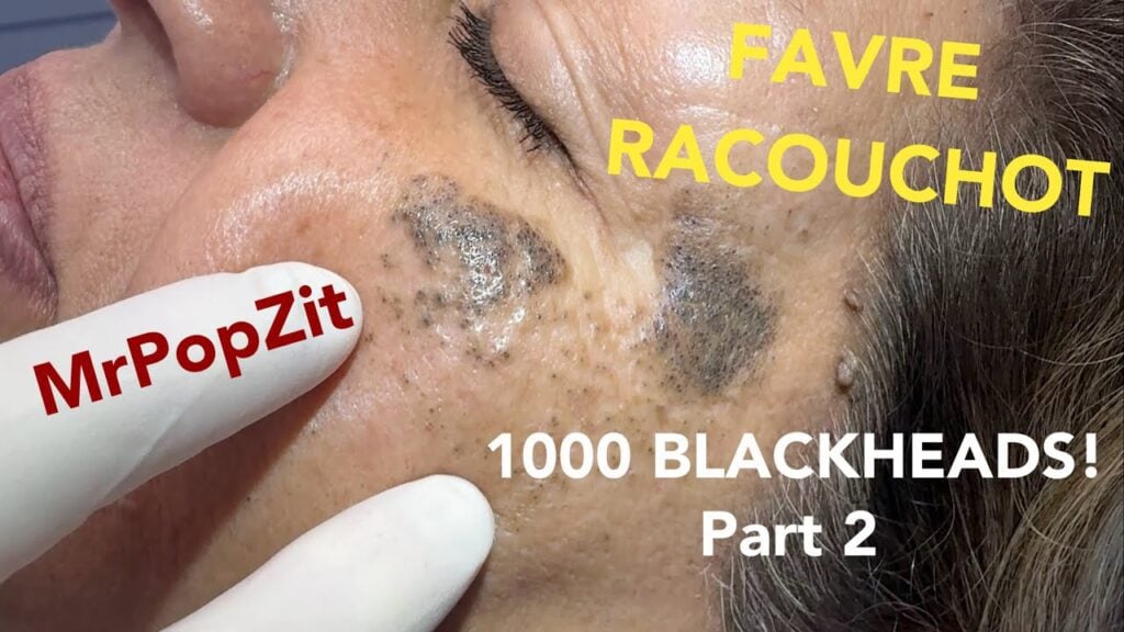 Here it is! 1,000 blackheads part 2.Unbelievable amount of keratin extracted from the cheeks! Favre! 1
