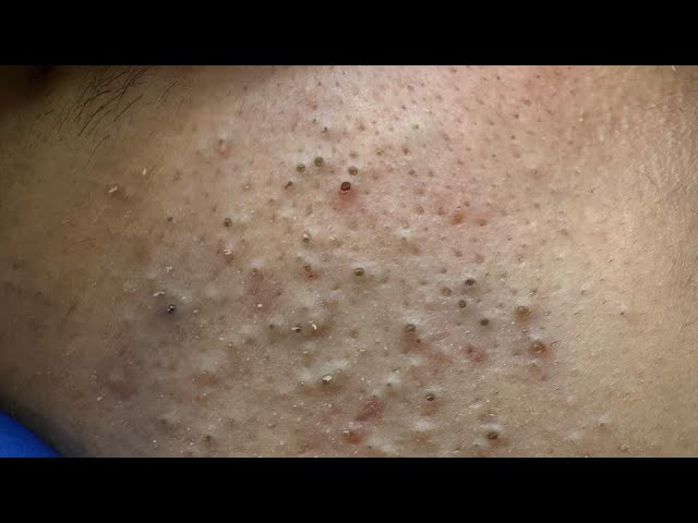 Deep Flow State: Blackhead Removal Method | "Fu" (Blessing) Seal & Unboxing White Ash 1