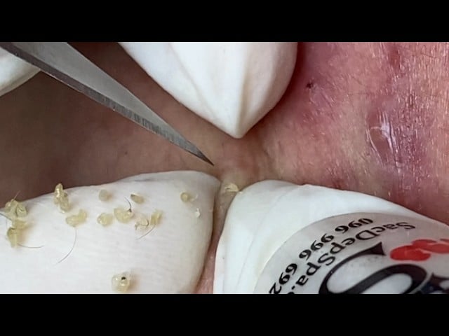 Deep Acne Extraction Session - SAC DEP SPA (MK, Part 4) 1