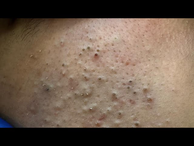 Amazing Technique for Removing Blackheads Without Irritation! | THIS Tool Works Like Magic 1