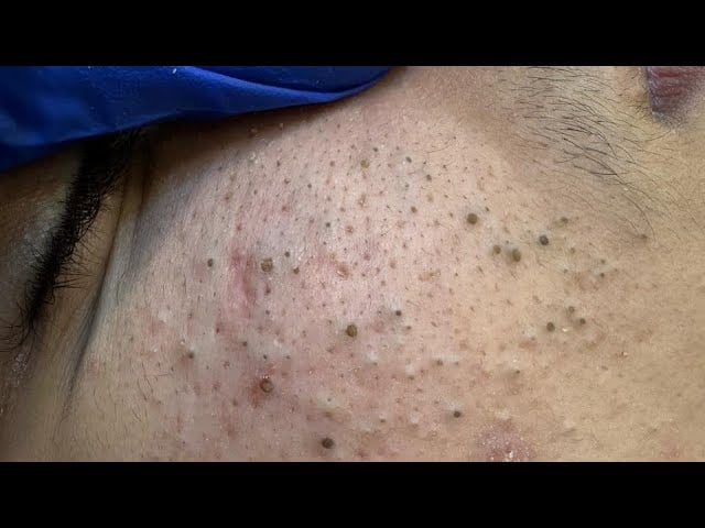 Blackhead Removal Hacks - How To Get Rid Of Blackheads Without PAIN! (Facial Care Solutions) 2026! 1