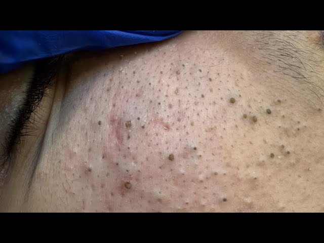 The ONLY blackhead removal solution video you’ll ever need to watch 1