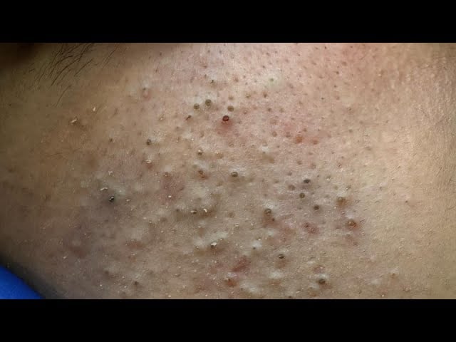 Deep Cleansing Techniques for Face | Ultimate Blackhead & Acne Eradication Routine 1